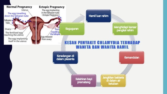 Chlamydia STD : KESAN CHLAMYDIA PADA WANITA DAN IBU MENGANDUNG