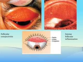 Follicular
conujnctivitis
Intense
follicular
inflammation
 