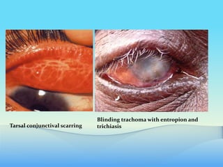 Tarsal conjunctival scarring
Blinding trachoma with entropion and
trichiasis
 