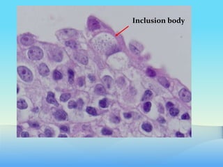 Inclusion body
 