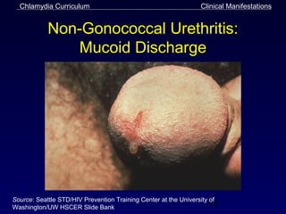 Chlamydia Curriculum                                           Clinical Manifestations


            Non-Gonococcal Urethritis:
                Mucoid Discharge




Source: Seattle STD/HIV Prevention Training Center at the University of
Washington/UW HSCER Slide Bank
                                                                    19
 