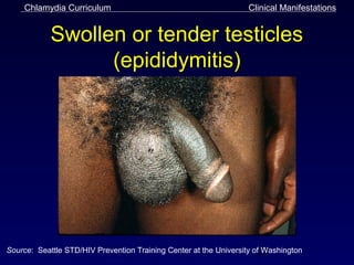 Chlamydia Curriculum                                           Clinical Manifestations


            Swollen or tender testicles
                  (epididymitis)




Source: Seattle STD/HIV Prevention Training Center at the University of21
                                                                        Washington
 