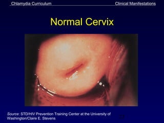 Chlamydia Curriculum                                            Clinical Manifestations



                          Normal Cervix




Source: STD/HIV Prevention Training Center at the University of
Washington/Claire E. Stevens                                        23
 