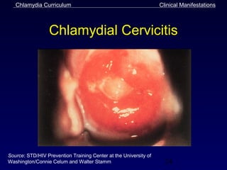 Chlamydia Curriculum                                           Clinical Manifestations



                  Chlamydial Cervicitis




Source: STD/HIV Prevention Training Center at the University of
Washington/Connie Celum and Walter Stamm                            24
 