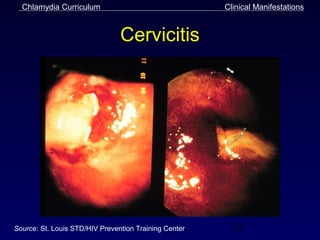 Chlamydia Curriculum                                 Clinical Manifestations


                                Cervicitis




Source: St. Louis STD/HIV Prevention Training Center     25
 