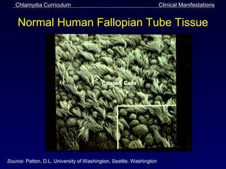 Chlamydia Curriculum                                              Clinical Manifestations


    Normal Human Fallopian Tube Tissue




Source: Patton, D.L. University of Washington, Seattle, Washington     27
 