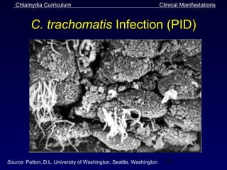 Chlamydia Curriculum                                              Clinical Manifestations


          C. trachomatis Infection (PID)




Source: Patton, D.L. University of Washington, Seattle, Washington     28
 