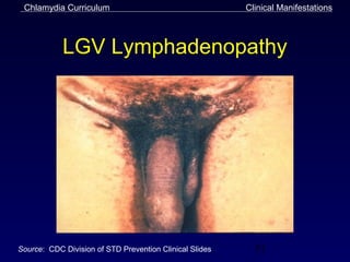 Chlamydia Curriculum                                    Clinical Manifestations



            LGV Lymphadenopathy




Source: CDC Division of STD Prevention Clinical Slides     31
 