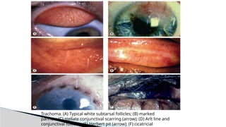 Trachoma. (A) Typical white subtarsal follicles; (B) marked
pannus; (C) stellate conjunctival scarring (arrow); (D) Arlt line and
conjunctival follicles; (E) Herbert pit (arrow); (F) cicatricial
 