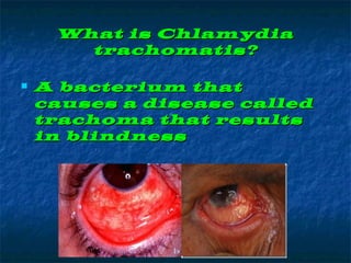 What is Chlamydia
trachomatis?
A bacterium that
causes a disease called
trachoma that results
in blindness