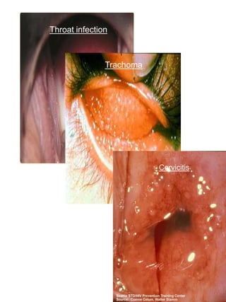 Throat infection



               Trachoma




                          Cervicitis
 