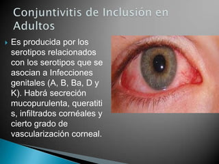  Es producida por los
serotipos relacionados
con los serotipos que se
asocian a Infecciones
genitales (A, B, Ba, D y
K). Habrá secreción
mucopurulenta, queratiti
s, infiltrados cornéales y
cierto grado de
vascularización corneal.
 