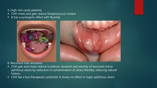 Chlorhexidine | PPTX