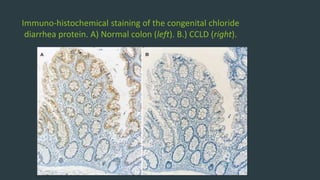 Immuno-histochemical staining of the congenital chloride
diarrhea protein. A) Normal colon (left). B.) CCLD (right).
 