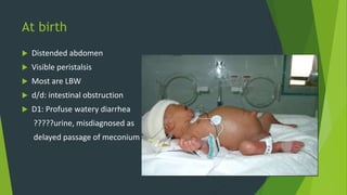 At birth
 Distended abdomen
 Visible peristalsis
 Most are LBW
 d/d: intestinal obstruction
 D1: Profuse watery diarrhea
?????urine, misdiagnosed as
delayed passage of meconium
 