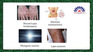 Disciod Lupus
Erythematosis
Infectious
mononucleosis
Photogenic reaction Lepra reactions
24
 