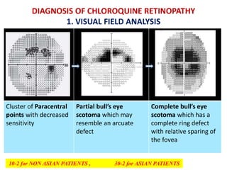 DIAGNOSIS OF CHLOROQUINE RETINOPATHY
1. VISUAL FIELD ANALYSIS
Cluster of Paracentral
points with decreased
sensitivity
Partial bull’s eye
scotoma which may
resemble an arcuate
defect
Complete bull’s eye
scotoma which has a
complete ring defect
with relative sparing of
the fovea
10-2 for NON ASIAN PATIENTS , 30-2 for ASIAN PATIENTS
 