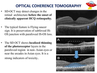 OPTICAL COHERENCE TOMOGRAPHY
• SD-OCT may detect changes in the
retinal architecture before the onset of
clinically apparent HCQ retinopathy.
• The typical feature is Flying saucer
sign. It is preservation of subfoveal IS-
OS junction with parafoveal IS-OS loss.
• The SD OCT shows localized thinning
of the photoreceptor layers in the
parafoveal region in non- Asian eyes or
near the arcades in Asian eyes. It is a
strong indicators of toxicity.
 