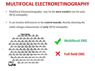 MULTIFOCAL ELECTRORETINOGRAPHY
• Multifocal Electroretinography may be the most sensitive test for early
HCQ retinopathy.
• It can localize deficiencies to the central macula, thereby detecting the
subtle changes characteristic of early HCQ retinopathy.
Multifocal ERG
Full field ERG
 
