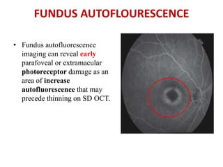 FUNDUS AUTOFLOURESCENCE
• Fundus autofluorescence
imaging can reveal early
parafoveal or extramacular
photoreceptor damage as an
area of increase
autofluorescence that may
precede thinning on SD OCT.
 