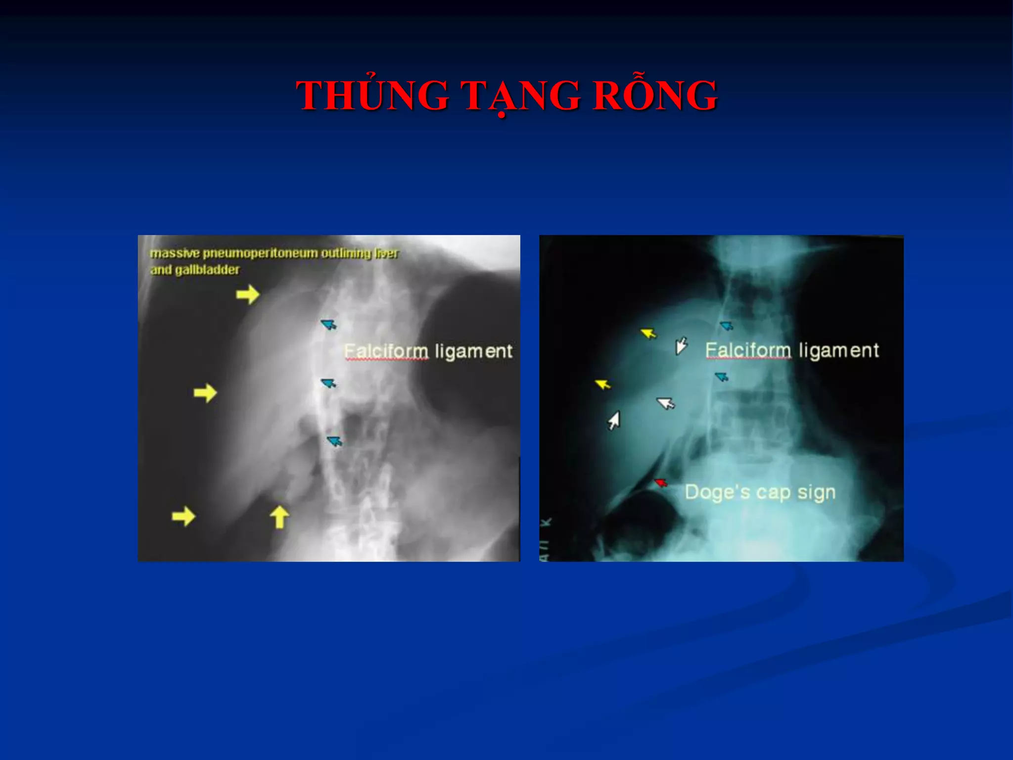 Chẩn đoán hình ảnh thủng tạng rỗng ok | PPTX