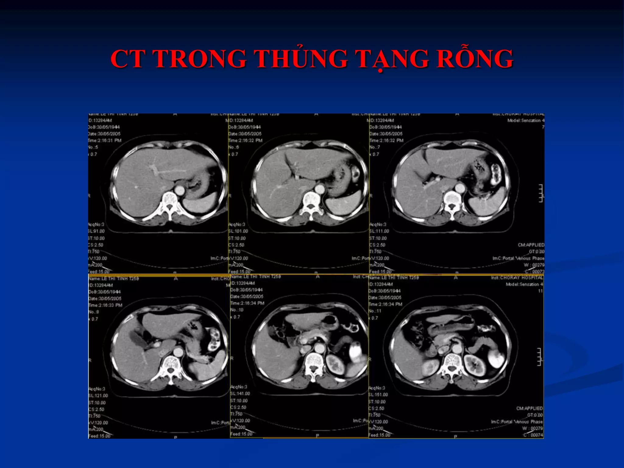 Chẩn đoán hình ảnh thủng tạng rỗng ok | PPTX