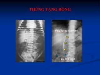 Chẩn đoán hình ảnh thủng tạng rỗng ok | PPTX
