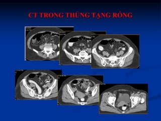 Chẩn đoán hình ảnh thủng tạng rỗng ok | PPTX