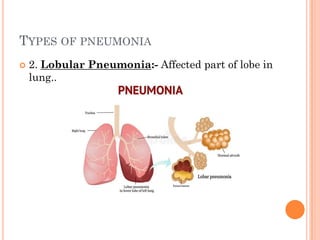 Pneumonia in children by shivam | PDF