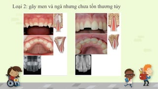 Loại 2: gãy men và ngà nhưng chưa tổn thương tủy
 