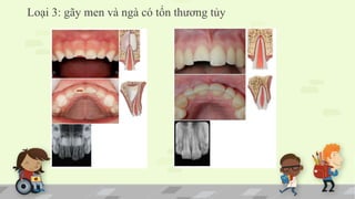 Loại 3: gãy men và ngà có tổn thương tủy
 