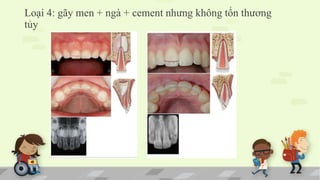 Loại 4: gãy men + ngà + cement nhưng không tổn thương
tủy
 