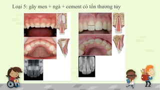 Loại 5: gãy men + ngà + cement có tổn thương tủy
 
