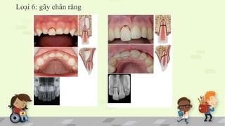 Loại 6: gãy chân răng
 