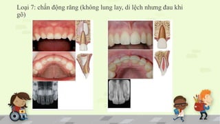 Loại 7: chấn động răng (không lung lay, di lệch nhưng đau khi
gõ)
 