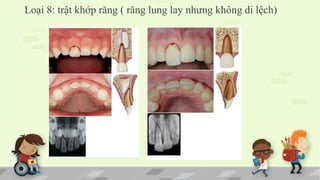 Loại 8: trật khớp răng ( răng lung lay nhưng không di lệch)
 