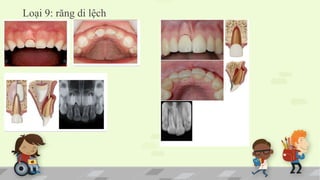 Loại 9: răng di lệch
 