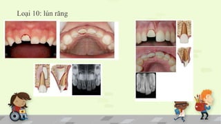 Loại 10: lún răng
 