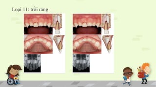 Loại 11: trồi răng
 