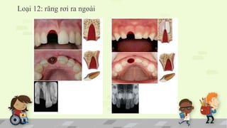 Loại 12: răng rơi ra ngoài
 