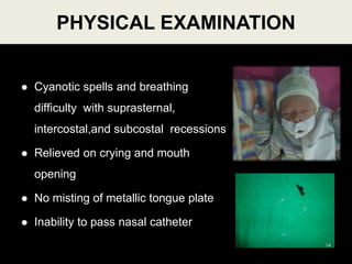  Cyanotic spells and breathing
difficulty with suprasternal,
intercostal,and subcostal recessions
 Relieved on crying and mouth
opening
 No misting of metallic tongue plate
 Inability to pass nasal catheter
PHYSICAL EXAMINATION
14
 
