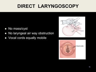  No mass/cyst
 No laryngeal air way obstruction
 Vocal cords equally mobile
15
DIRECT LARYNGOSCOPY
 