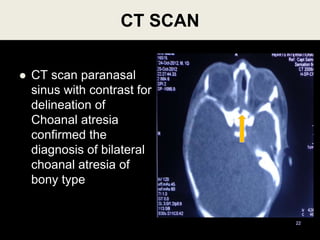 CT SCAN
 CT scan paranasal
sinus with contrast for
delineation of
Choanal atresia
confirmed the
diagnosis of bilateral
choanal atresia of
bony type
22
 