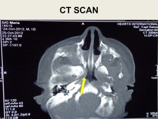 CT SCAN
23
 