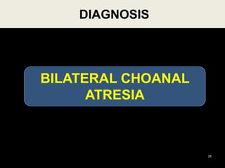 DIAGNOSIS
26
BILATERAL CHOANAL
ATRESIA
 