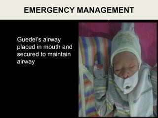 Case Summary
Guedel’s airway
placed in mouth and
secured to maintain
airway
27
EMERGENCY MANAGEMENT
 