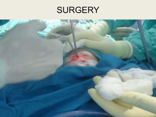 44
SURGERY
 