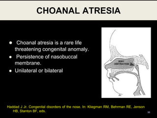  Choanal atresia is a rare life
threatening congenital anomaly.
 Persistence of nasobuccal
membrane.
 Unilateral or bilateral
CHOANAL ATRESIA
55
Haddad J Jr. Congenital disorders of the nose. In: Kliegman RM, Behrman RE, Jenson
HB, Stanton BF, eds.
 