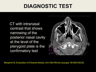 DIAGNOSTIC TEST
CT with intranasal
contrast that shows
narrowing of the
posterior nasal cavity
at the level of the
pterygoid plate is the
confirmatory test
Benjamin B. Evaluation of Choanal Atresia. Ann Otol Rhinol Laryngol. 94:429-432.63
 