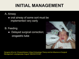 A. Airway
 oral airway of some sort must be
implemented very early
B. Feeding
 Delayed surgical correction;
orogastric tube
INITIAL MANAGEMENT
Hengerer AS et al. Choanal Atresia: A New Embryologic Theory and Its Influence on Surgical
Management. Laryngoscope. August 1982;92:913-921.
 